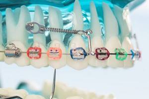 Щель между передними и другими зубами: как исправить и убрать дырку
